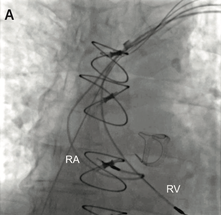 Transvenous Lead Extraction: From Simple Traction to Internal Transjugular Approach [ペーパーバック] Bongiorni， Maria Grazia B-IN02-04 TRANSHEPATIC ACCESS TO FACILITATE LEAD EXTRACTION
